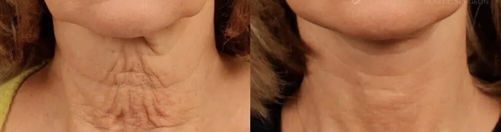 Neck & fine lines — before and after