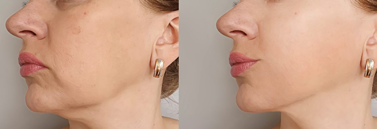 Jawline & firmness — before and after